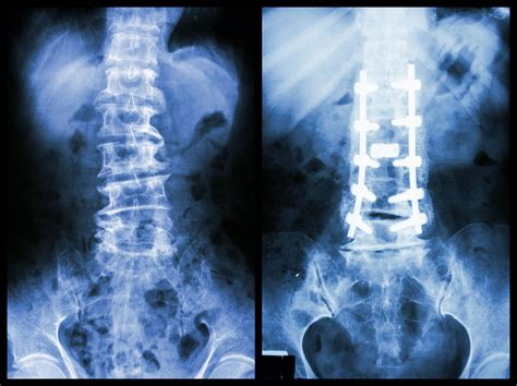 broke my metal bracket on neck fusion|broken spine hardware.